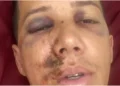 Árbitro desabafa após ser agredido em Minas: “Poderia estar em cadeira de rodas”